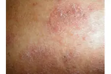 Genital Bölge Kızarıklık Belirtileri ve Tedavisi