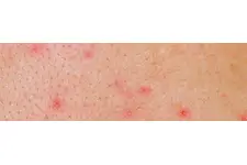 Genital Uçuk Belirtileri ve Tedavisi